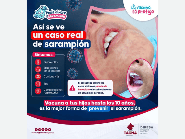 SARAMPIÓN: SÍNTOMAS, PREVENCIÓN Y VACUNACIÓN